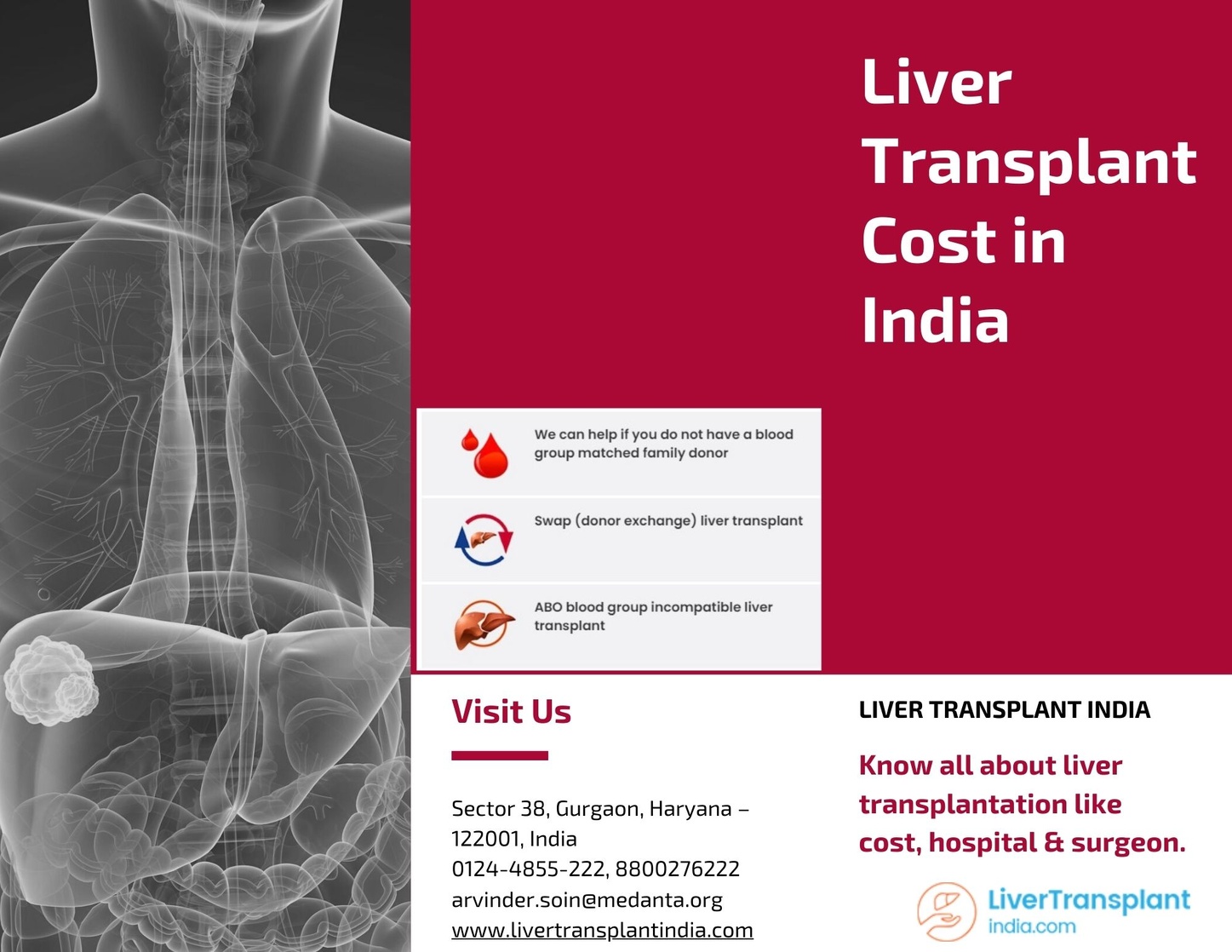 Right Cost of Liver Transplantation in India