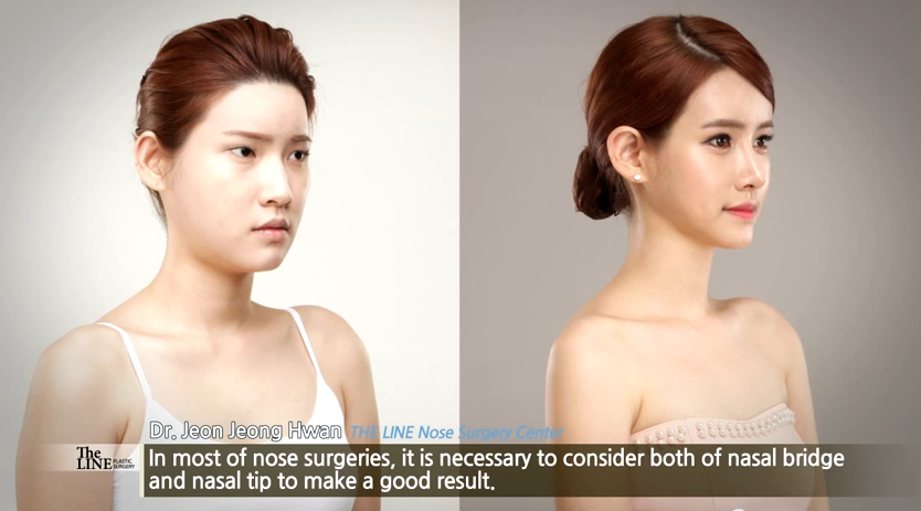 Nose Rhinoplasty at Korea's The LINE Clinic